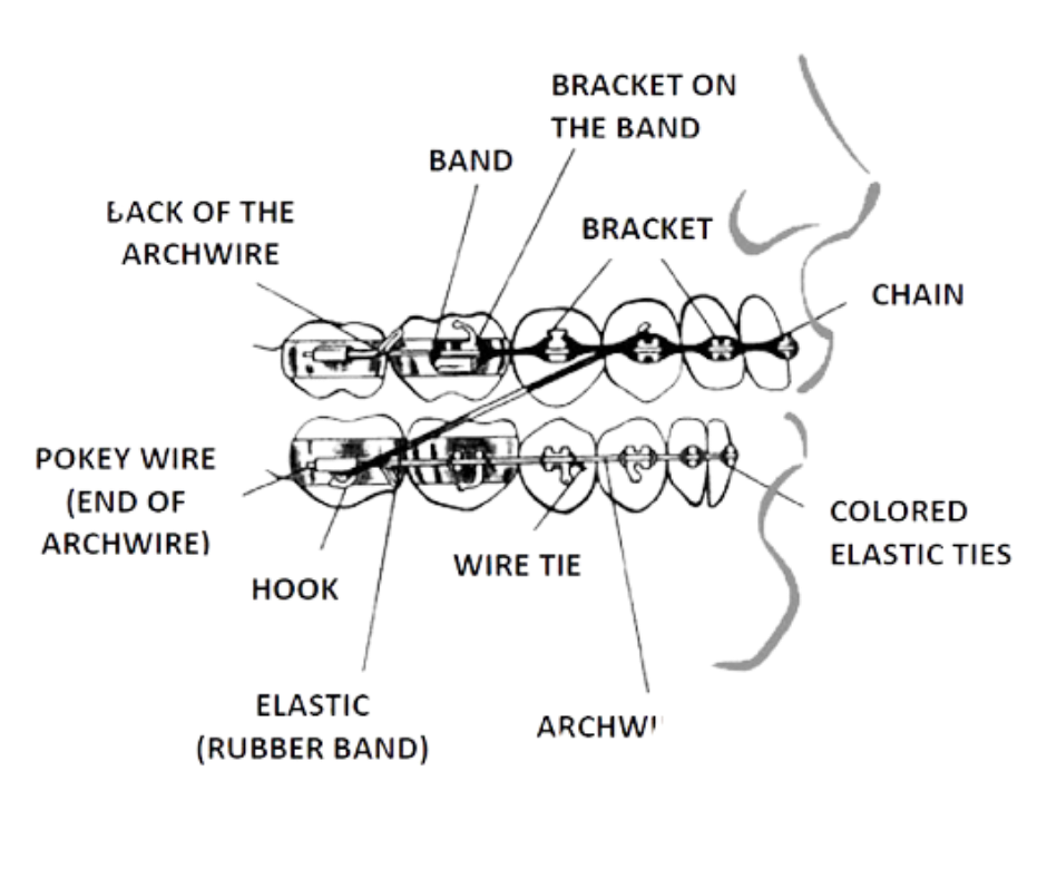 Plans For Braces